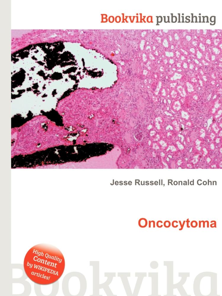 High Quality Content by WIKIPEDIA articles! An oncocytoma is a tumor ...